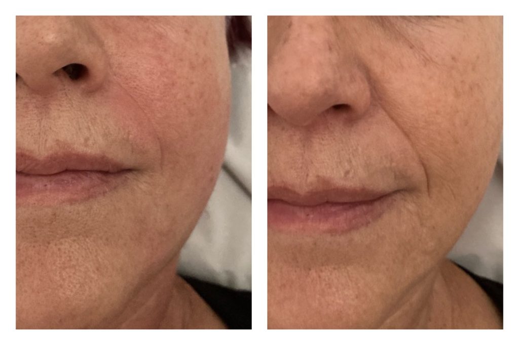 mejora del rictus con masaje