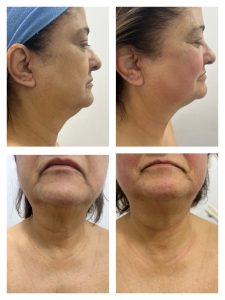 kinesiolifting para mejorar la papada